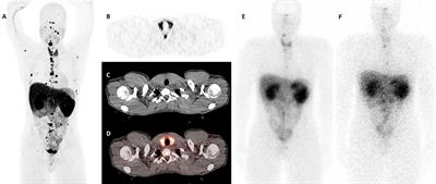 Case Report: Primary Hypothyroidism Associated With Lutetium 177-DOTATATE Therapy for Metastatic Paraganglioma